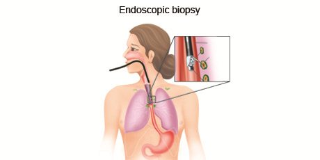 cancer-treatemt-image