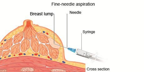 cancer-treatemt-image