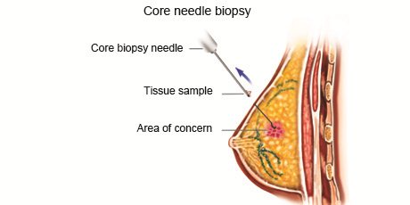 cancer-treatemt-image
