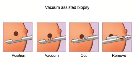 cancer-treatemt-image