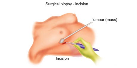 cancer-treatemt-image
