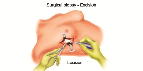 cancer-treatemt-image