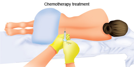 cancer-treatemt-image