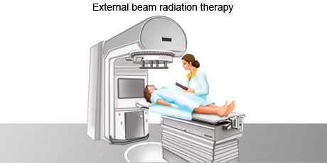 cancer-treatemt-image