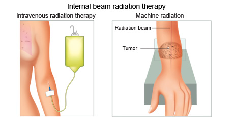 cancer-treatemt-image