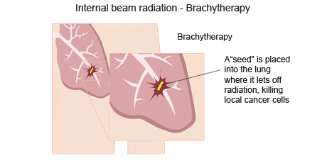 cancer-treatemt-image