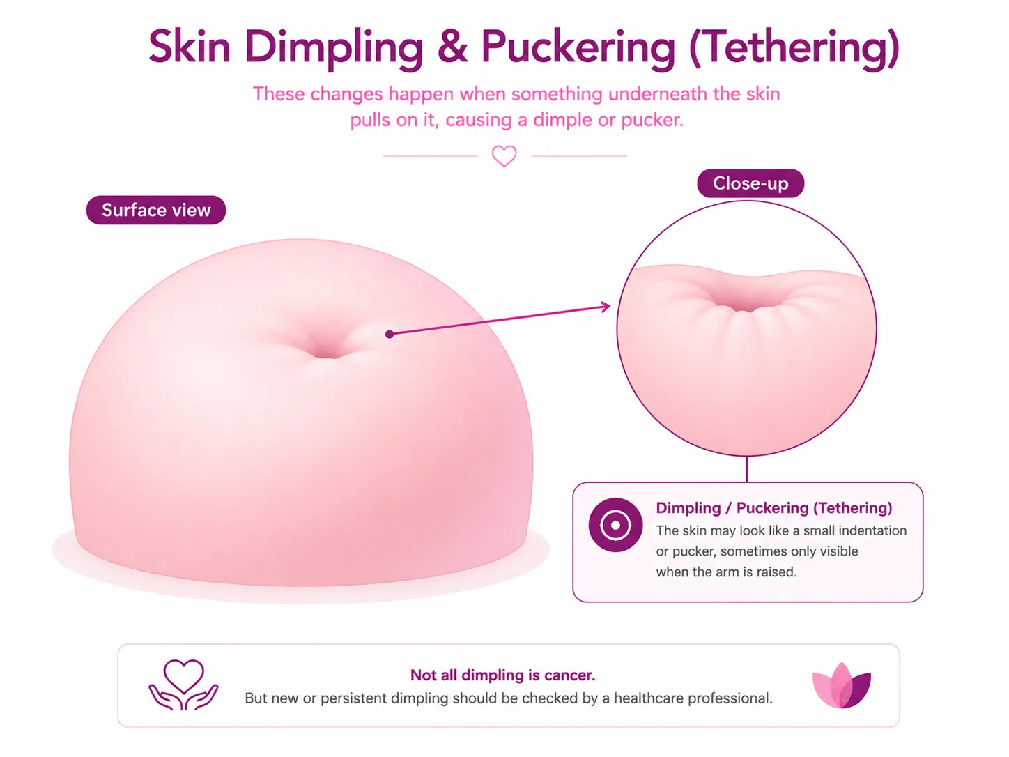 Illustration of breast skin dimpling and puckering (tethering) — a surface view showing an inward dimple and a close-up of the puckered, pulled-in skin, with a note that not all dimpling is cancer
