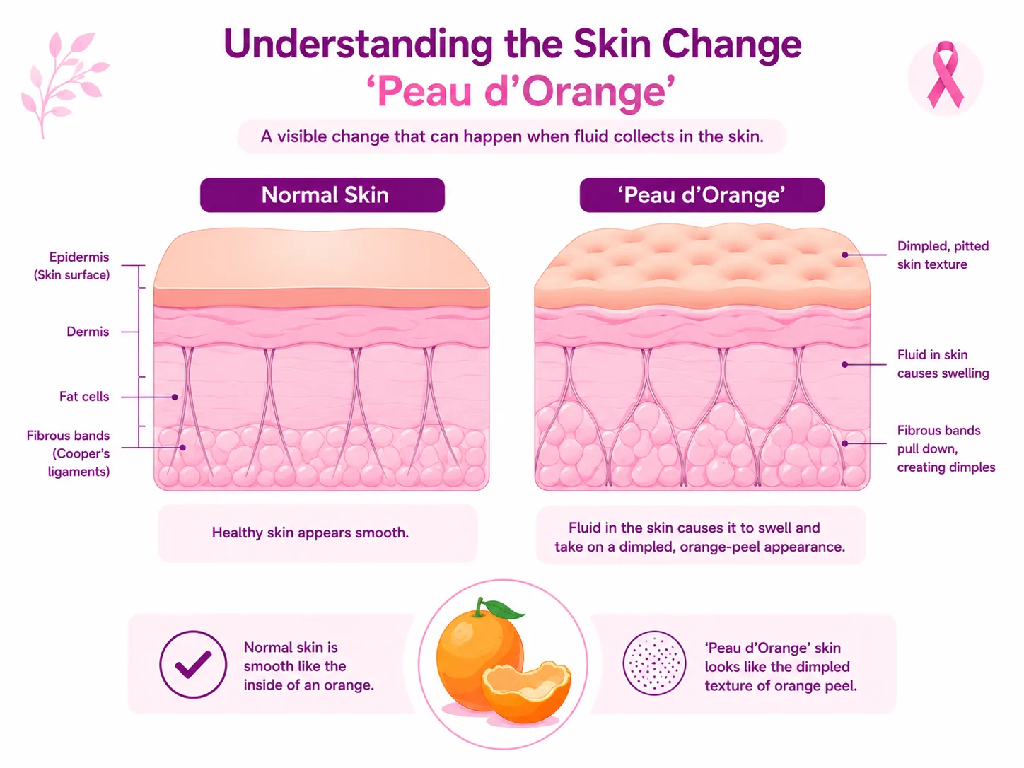 Diagram comparing normal breast skin with peau d'orange skin — showing how fluid building up in the dermis makes the surface swell while tethered hair follicles are pulled inward, creating a dimpled, pitted, orange-peel texture