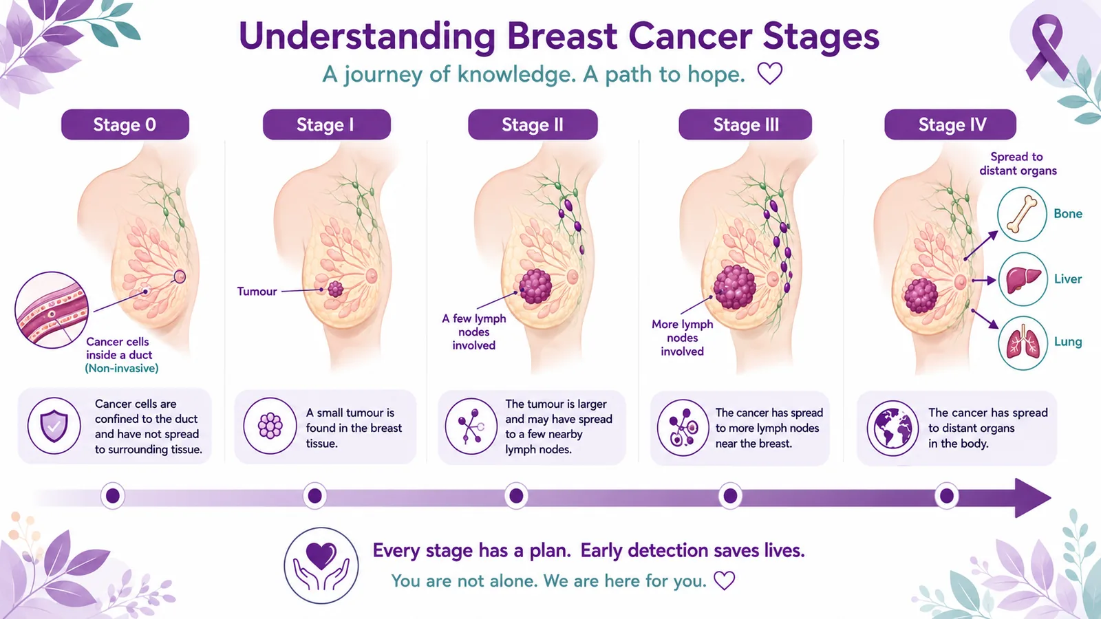 Understanding breast cancer stages 0 to IV — from cancer cells confined inside a duct, to a small tumour in the breast tissue, to spread to a few and then more lymph nodes, and finally spread to distant organs such as bone, liver and lung