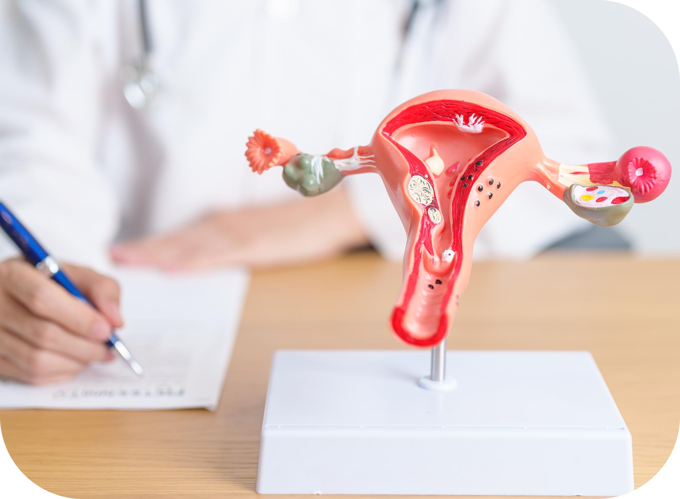 Hysterectomy Model