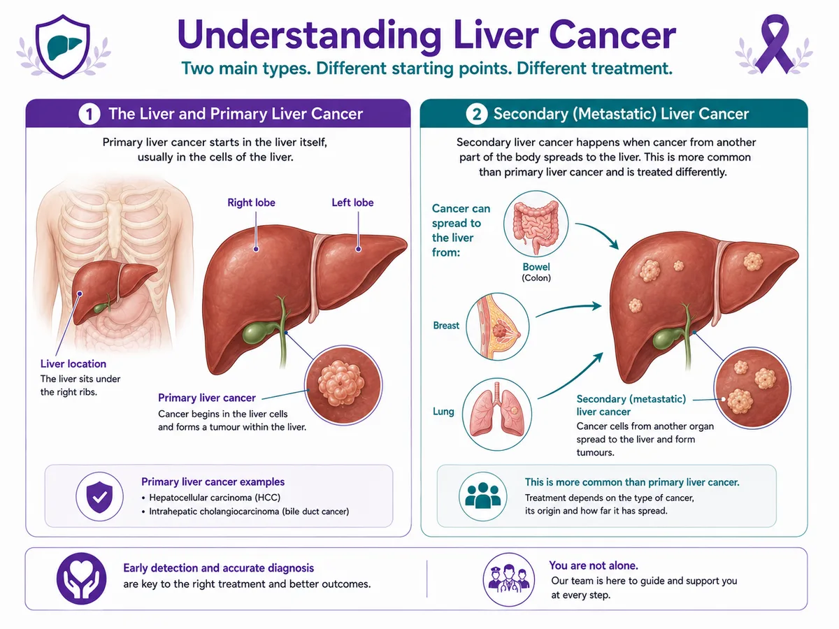 Understanding liver cancer — the liver and its lobes, primary liver cancer (HCC) versus secondary cancer that spreads to the liver