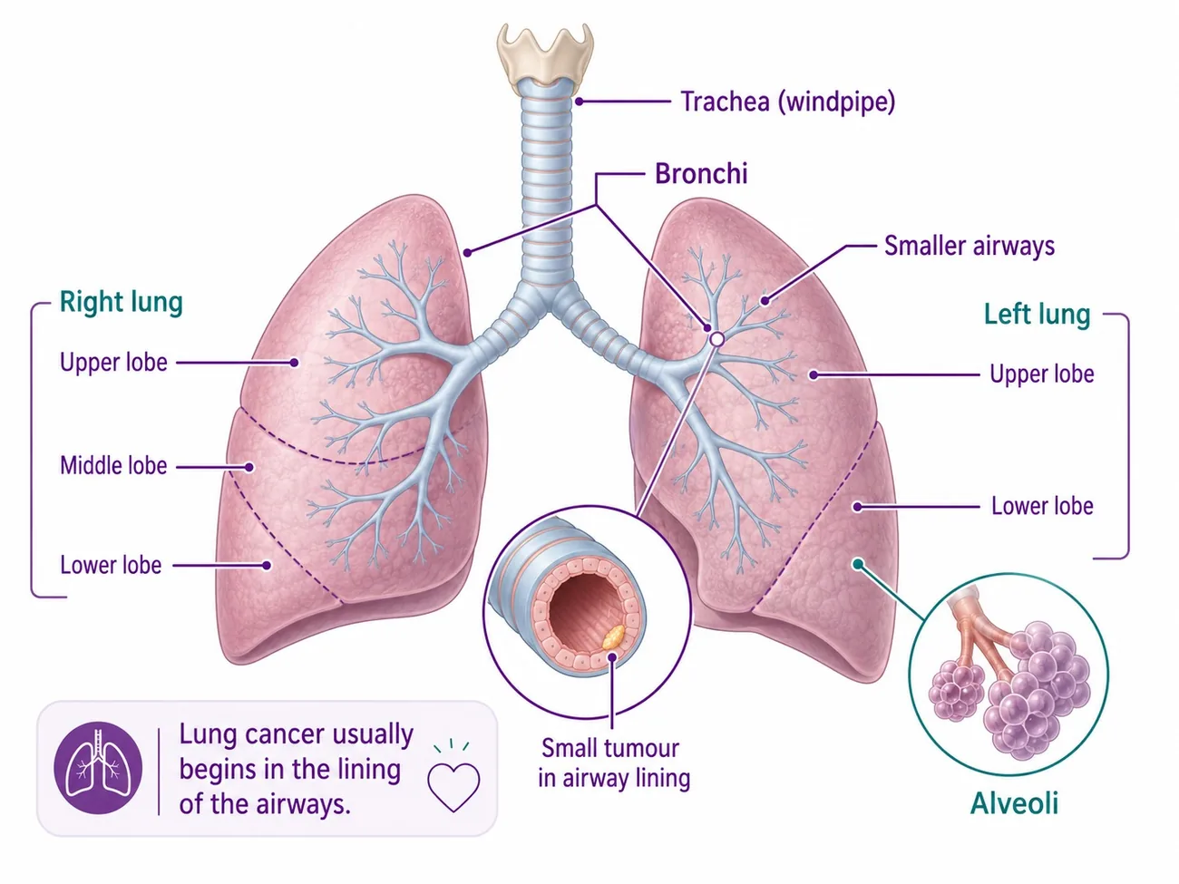 Lung and airway anatomy — the trachea, bronchi, lobes and alveoli, and where lung cancer begins in the lining of the airways