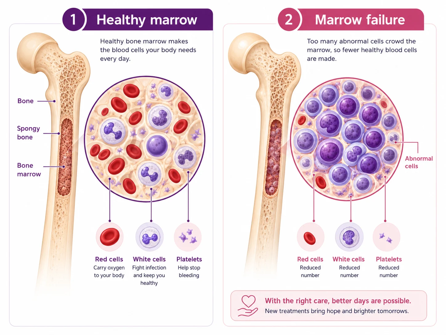 Labelled illustration comparing healthy bone marrow producing red cells, white cells and platelets with marrow failure where abnormal cells crowd them out — CION Cancer Clinics, Hyderabad