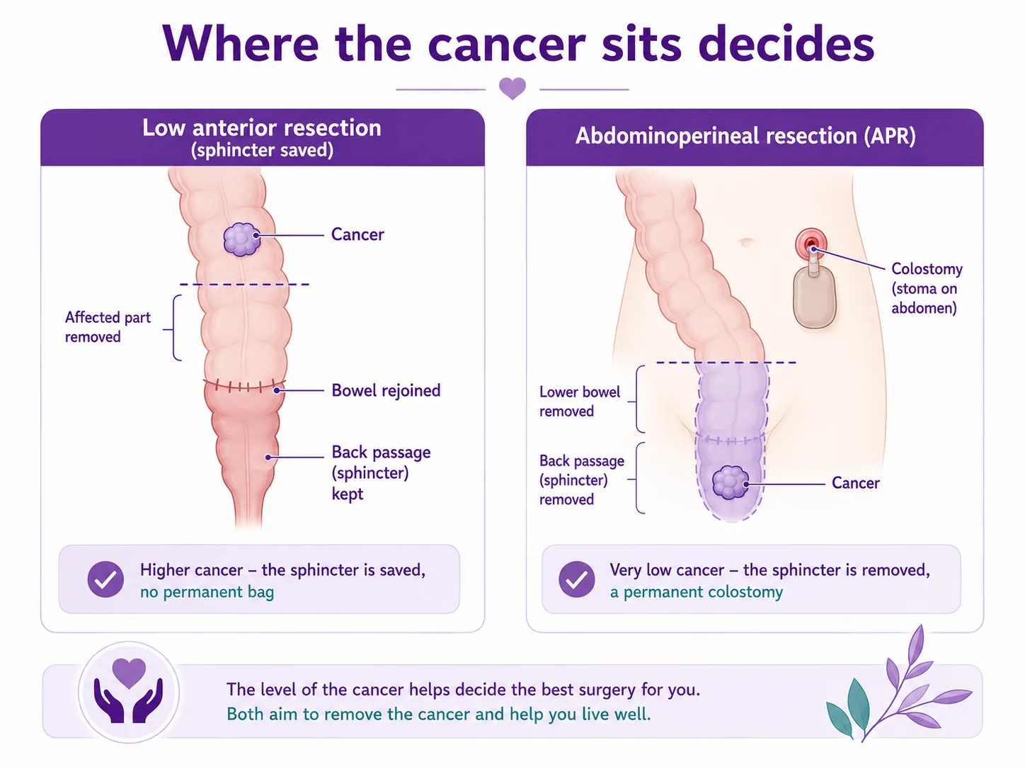 Diagram comparing a sphincter-saving low anterior resection (higher rectal cancer, bowel rejoined, no permanent bag) and an abdominoperineal resection or APR (very low cancer at the sphincter, a permanent colostomy), CION Cancer Clinics Hyderabad