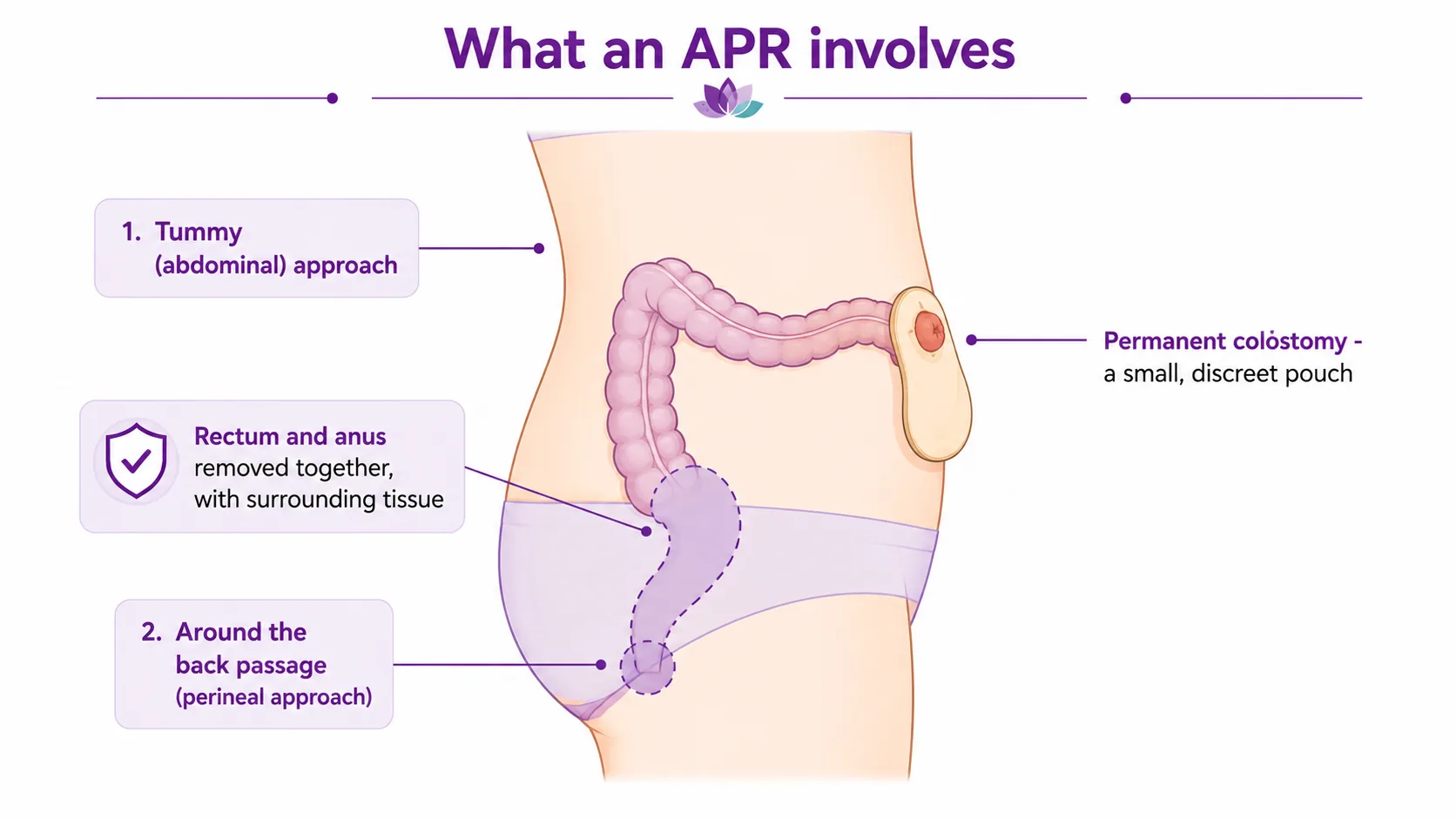 Diagram of what an abdominoperineal resection involves — the abdominal and perineal approaches, the rectum and anus removed together, and a permanent colostomy on the abdomen, CION Cancer Clinics Hyderabad