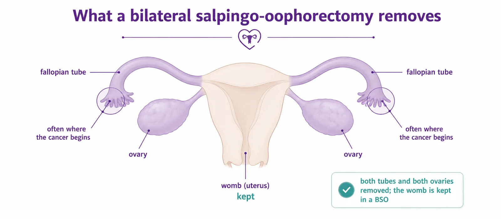 Diagram of a bilateral salpingo-oophorectomy showing both ovaries and both fallopian tubes removed while the womb is kept, with the far end of each tube highlighted as where many ovarian cancers begin