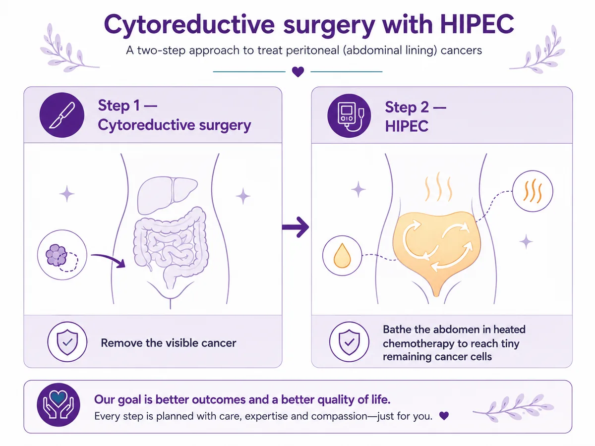 Two-step diagram of cytoreductive surgery followed by HIPEC — Step 1 remove the visible cancer, Step 2 bathe the abdomen in heated chemotherapy to reach tiny remaining cancer cells, CION Cancer Clinics Hyderabad