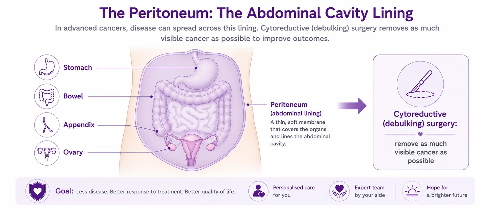 Map of the advanced cancers debulking surgery treats — ovary, bowel, appendix and stomach spreading to the peritoneum (abdominal lining), CION Cancer Clinics Hyderabad