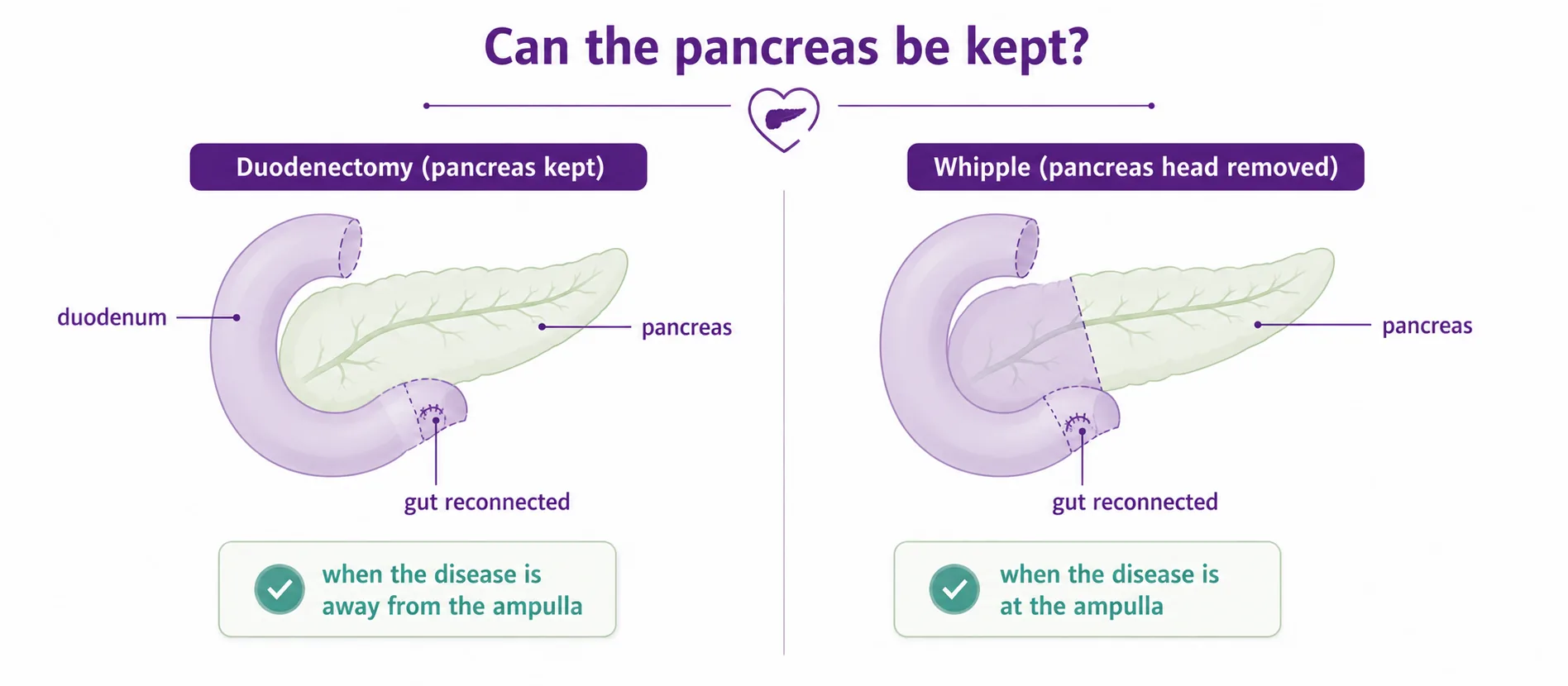 Diagram comparing a duodenectomy that keeps the pancreas with a Whipple that removes the head of the pancreas too, showing the pancreas can be spared when the disease is away from the ampulla