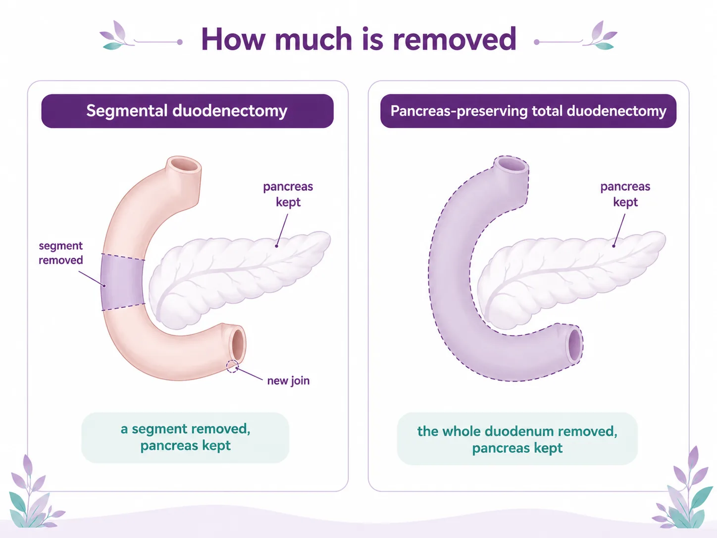 Diagram comparing a segmental duodenectomy with a pancreas-preserving total duodenectomy, showing how much of the duodenum is removed while keeping the pancreas