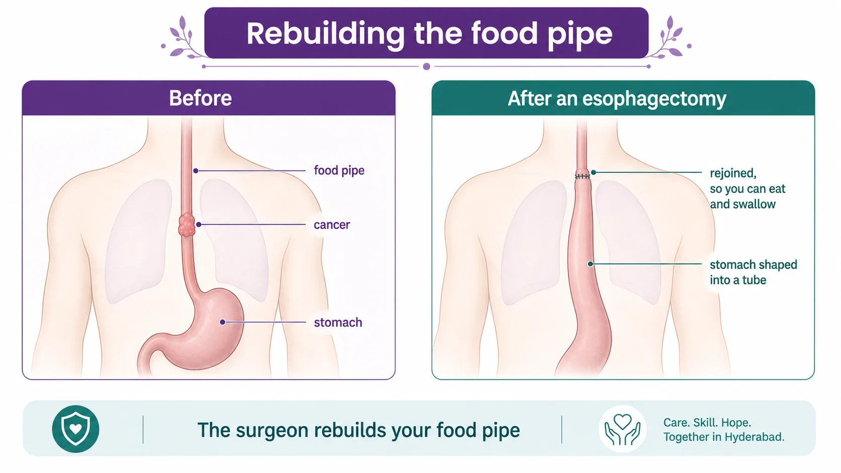 Diagram showing how an esophagectomy rebuilds the food pipe by shaping the stomach into a tube and pulling it up to rejoin the remaining food pipe, so you can eat and swallow again