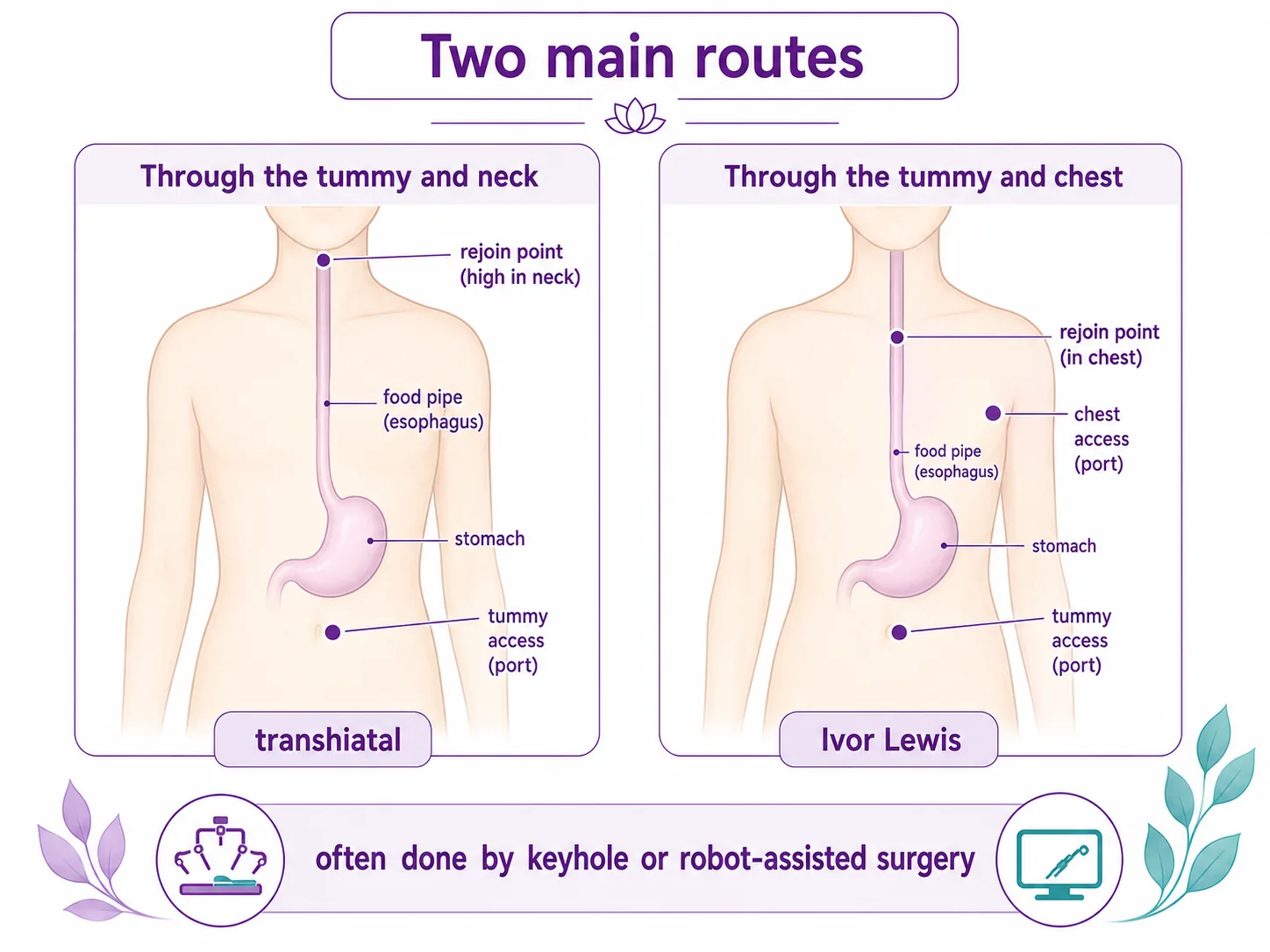 Diagram comparing the two main esophagectomy routes — transhiatal through the tummy and neck versus Ivor Lewis through the tummy and chest — often done by keyhole or robot-assisted surgery