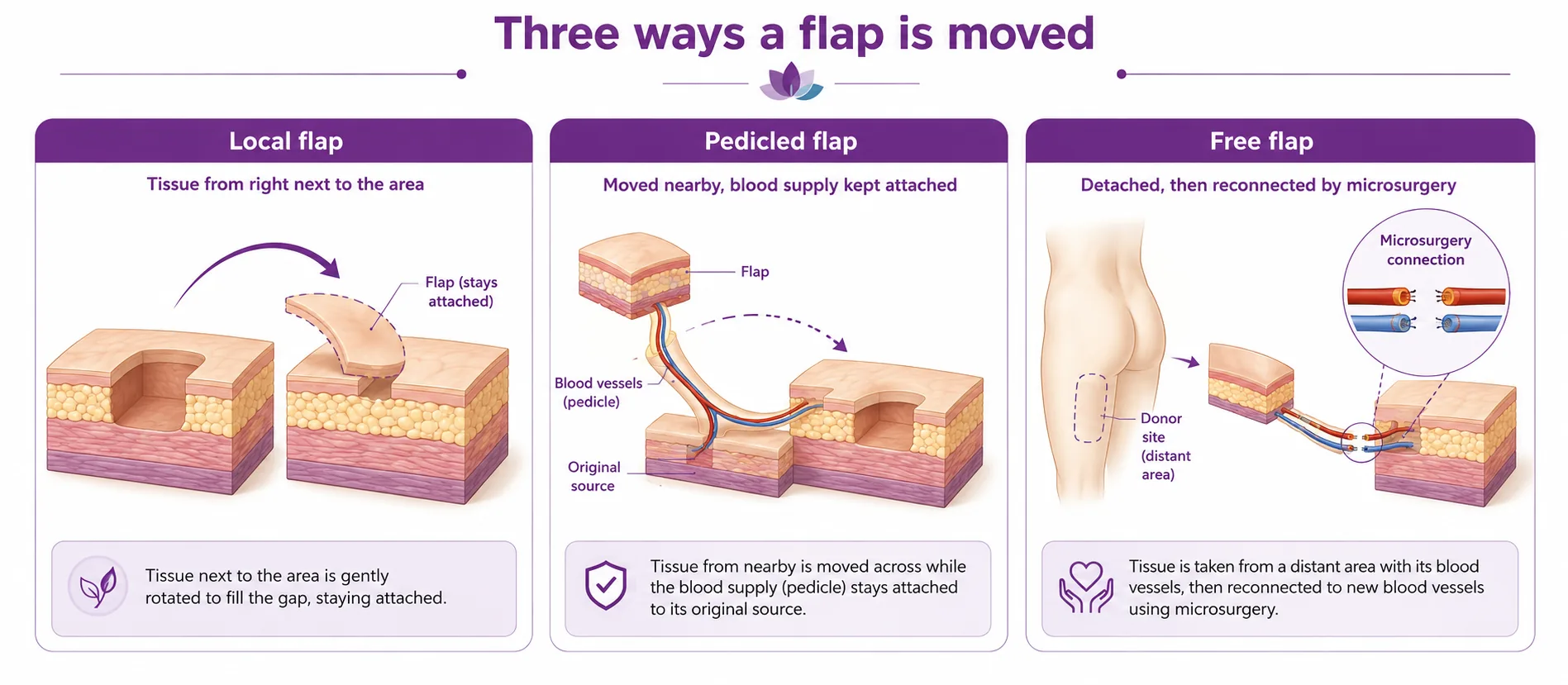 Diagram comparing local, pedicled and free flaps — how tissue and its blood supply are moved to rebuild an area, with free flaps reconnected by microsurgery, CION Cancer Clinics Hyderabad