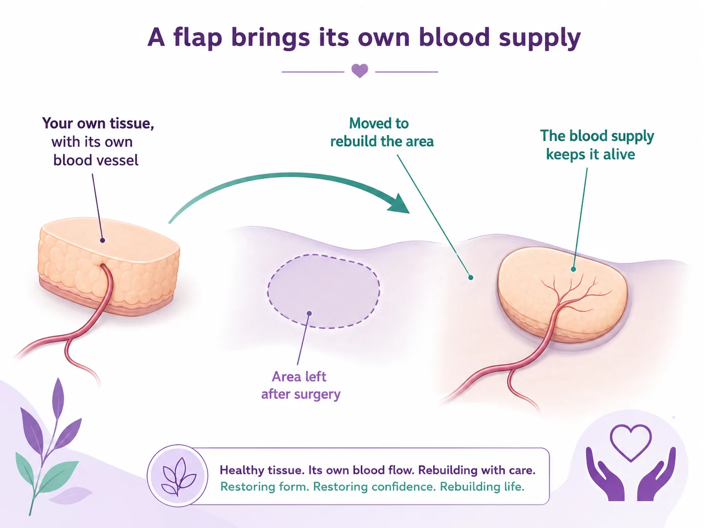 Diagram showing what a flap is — the body's own tissue moved with its own blood vessel to rebuild an area after cancer surgery, unlike an implant or a graft, CION Cancer Clinics Hyderabad