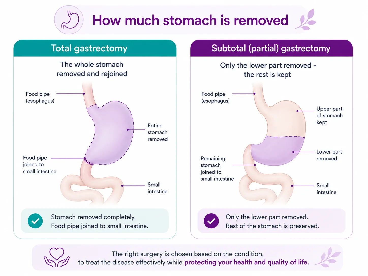 Diagram comparing total gastrectomy (whole stomach removed and the food pipe rejoined to the small intestine) and subtotal gastrectomy (only the lower part removed, the upper stomach kept) for stomach cancer