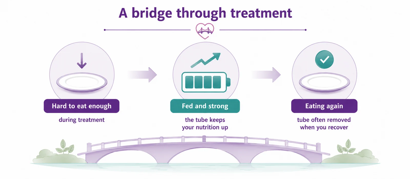 Diagram showing a feeding tube as a temporary bridge through cancer treatment — hard to eat during treatment, kept fed and strong by the tube, then eating again with the tube often removed on recovery, CION Cancer Clinics Hyderabad