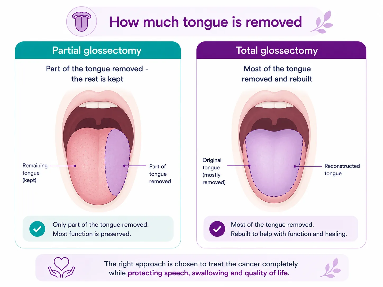 Diagram comparing partial glossectomy (part of the tongue removed, the rest kept) and total glossectomy (most of the tongue removed and rebuilt) for tongue cancer, CION Cancer Clinics Hyderabad