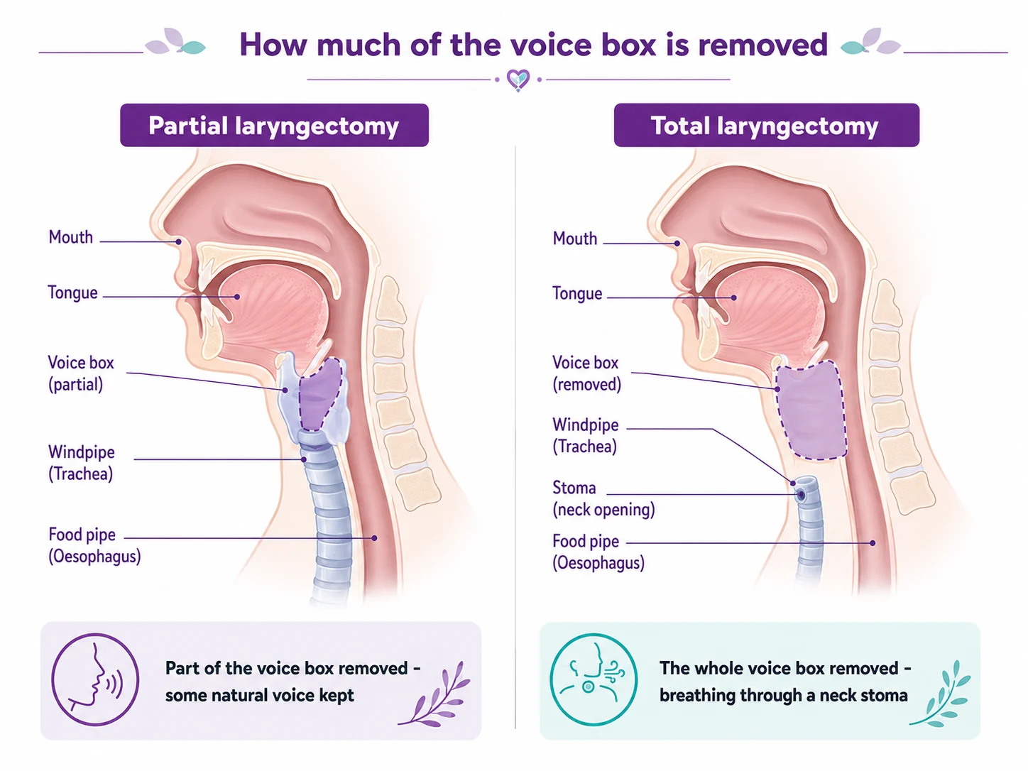 Diagram comparing partial laryngectomy (part of the voice box removed, some natural voice kept) and total laryngectomy (the whole voice box removed, breathing through a neck stoma) for voice-box cancer, CION Cancer Clinics Hyderabad