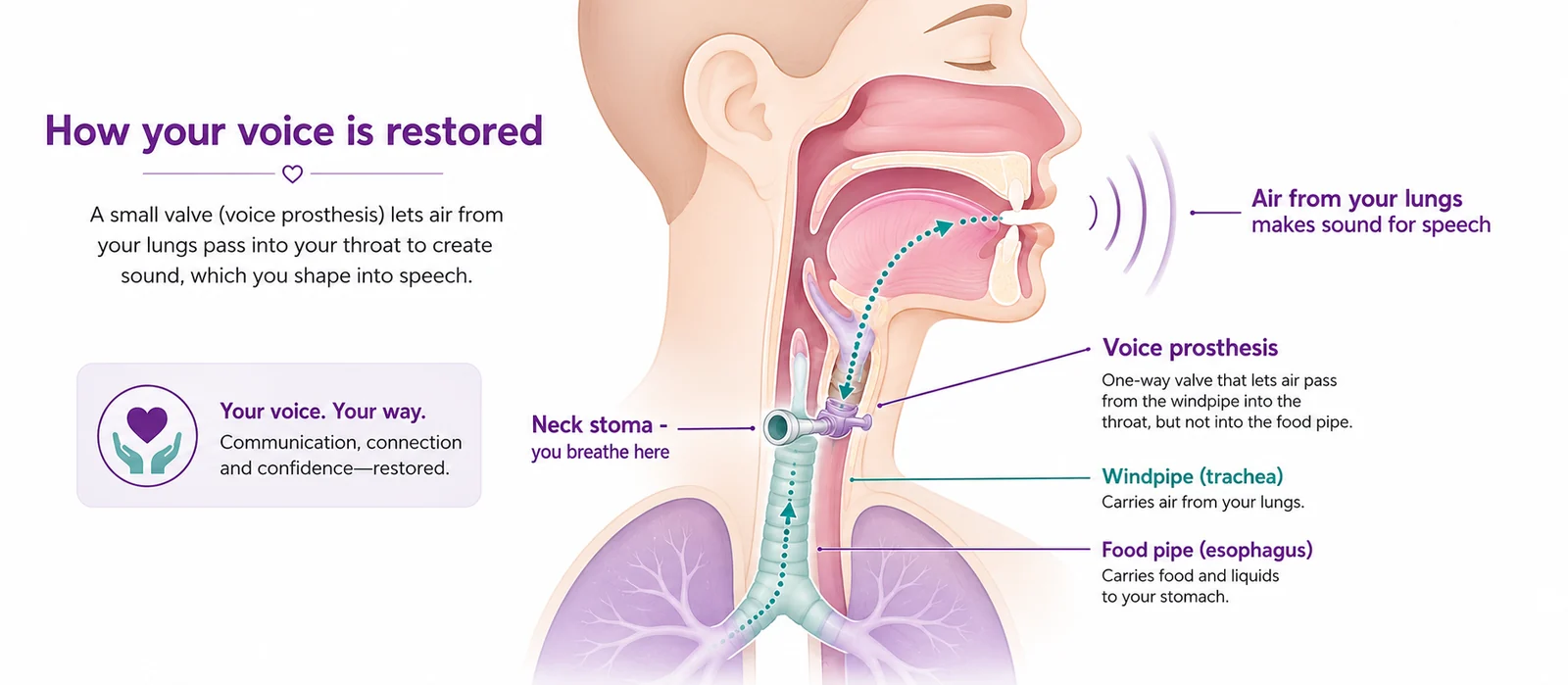 Diagram showing voice restoration after a total laryngectomy — a voice prosthesis lets air from the lungs pass from the windpipe to the food pipe to make sound for speech, with a neck stoma for breathing, CION Cancer Clinics Hyderabad
