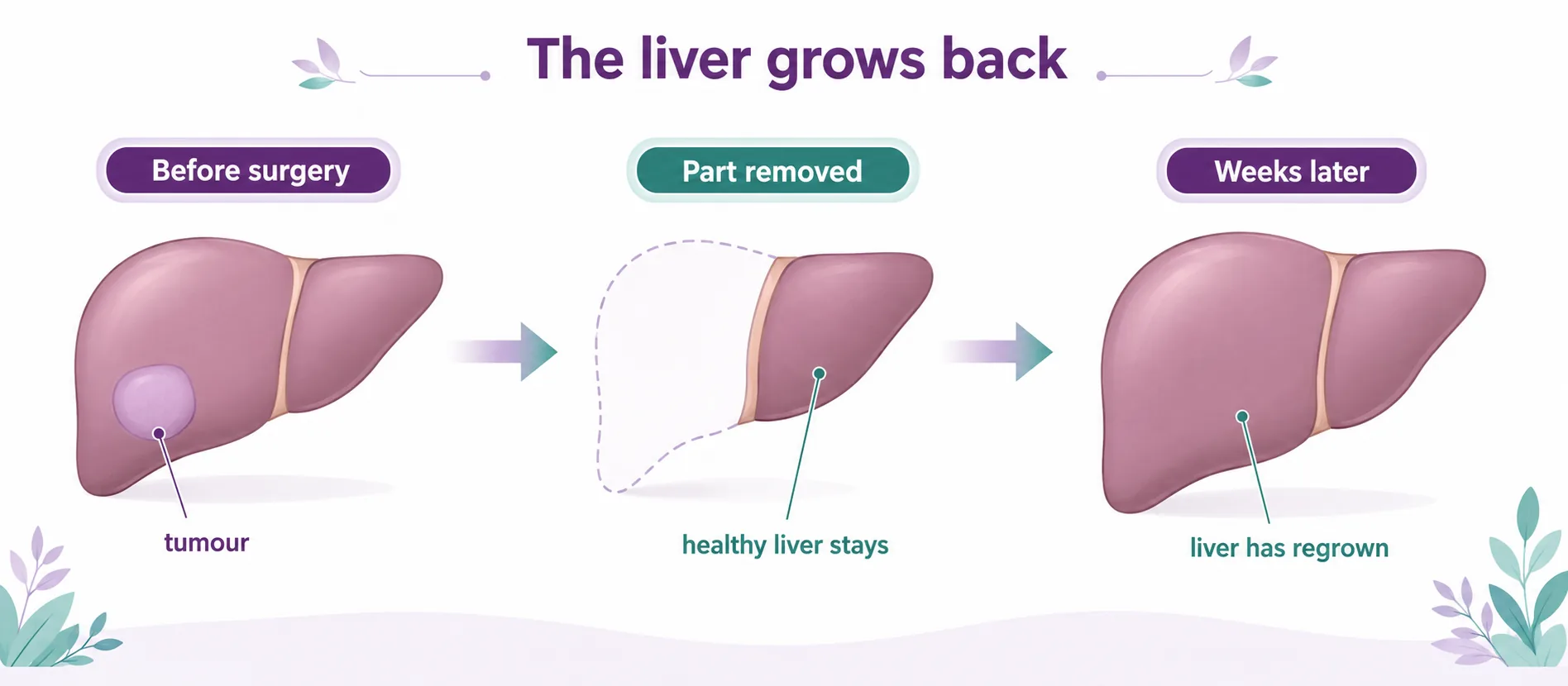Diagram showing how the liver regenerates after a resection — part of the liver is removed with the tumour and the remaining healthy liver regrows to near-full size over weeks, CION Cancer Clinics Hyderabad