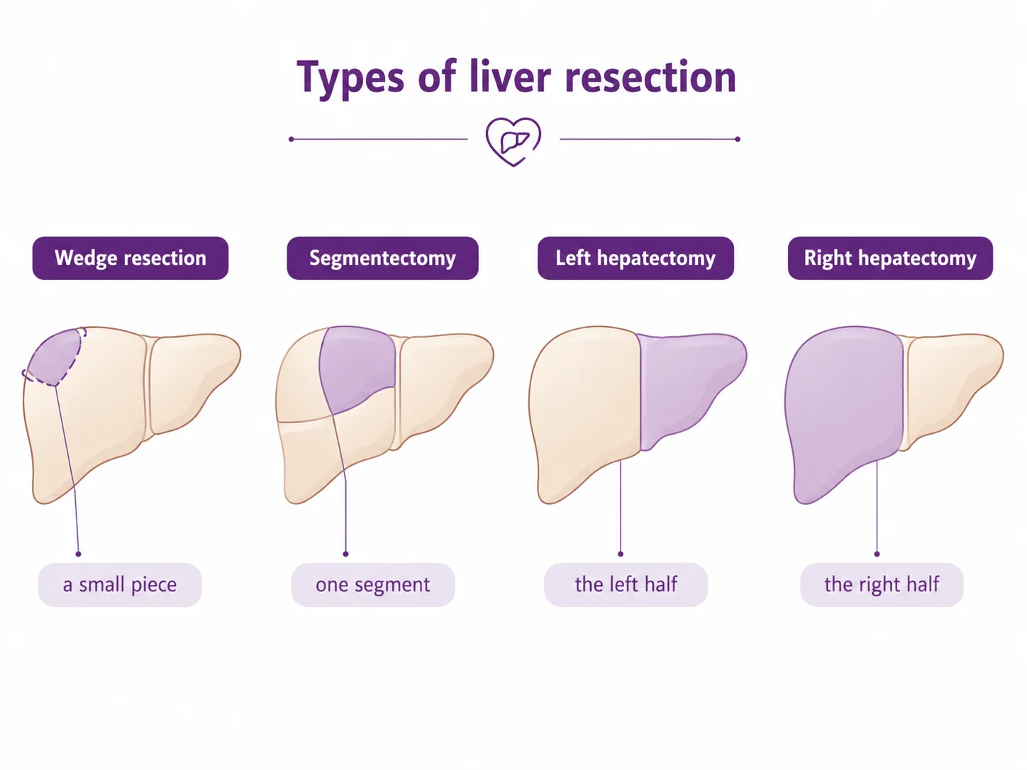 Diagram comparing types of liver resection — wedge resection, segmentectomy, left hepatectomy and right hepatectomy — showing how much of the liver is removed, CION Cancer Clinics Hyderabad