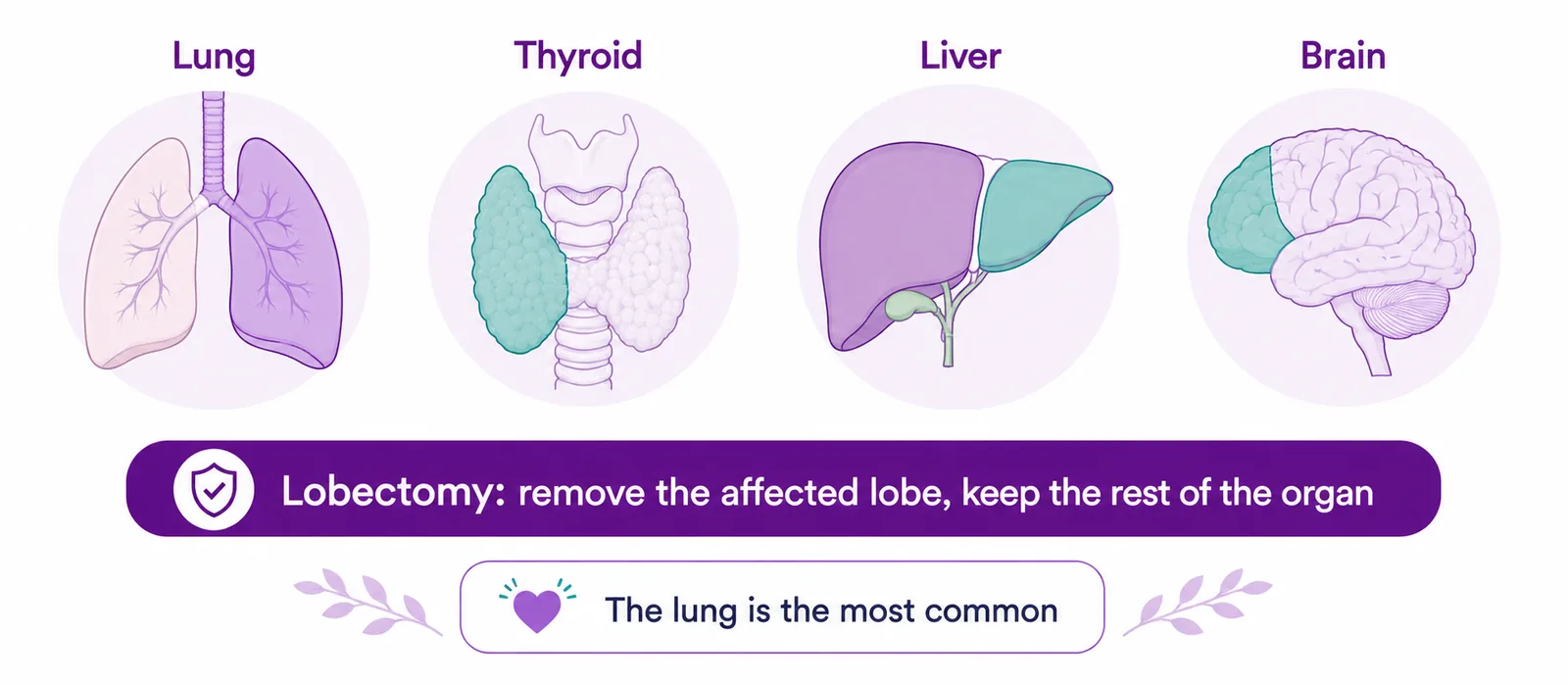 Map of organs that have lobes — lung, thyroid, liver and brain — where a lobectomy removes the affected lobe while keeping the rest of the organ, CION Cancer Clinics Hyderabad