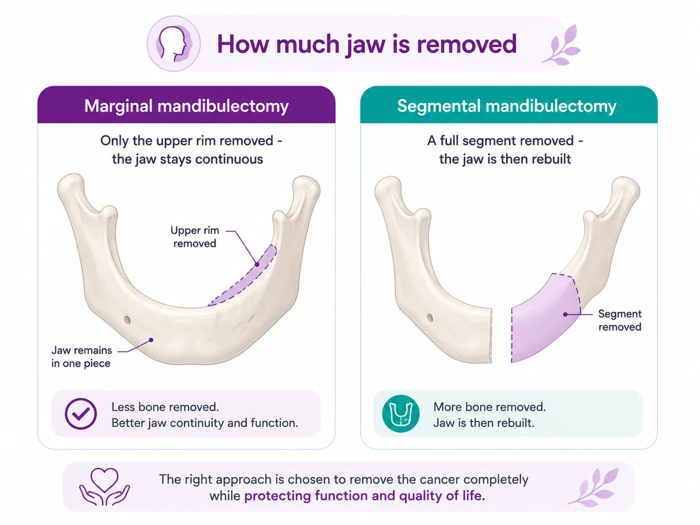 Diagram comparing marginal and segmental mandibulectomy of the lower jaw — the upper rim removed with the jaw staying continuous, versus a full segment removed which is then rebuilt