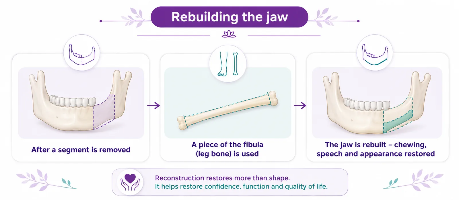 Diagram of jaw reconstruction after segmental mandibulectomy using a fibula (leg bone) free flap — the segment removed, a piece of fibula shaped to fit, and the jaw rebuilt so chewing, speech and appearance are restored