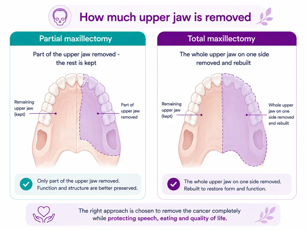 Diagram comparing partial maxillectomy (part of the upper jaw removed, the rest kept) and total maxillectomy (the whole upper jaw on one side removed and rebuilt) for upper-jaw cancer, CION Cancer Clinics Hyderabad