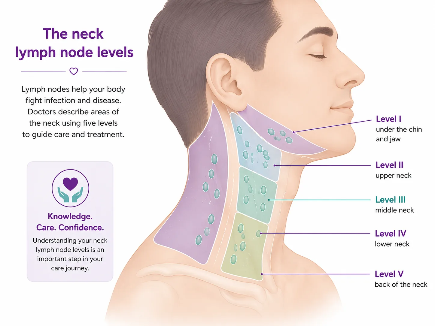 Diagram of the neck lymph node levels I to V — Level I under the chin and jaw, Level II upper neck, Level III middle neck, Level IV lower neck and Level V back of the neck — showing where the neck lymph nodes sit and are cleared in a neck dissection, CION Cancer Clinics Hyderabad