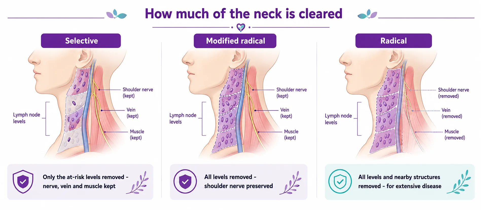 Diagram comparing selective, modified radical and radical neck dissection — a selective dissection removes only the at-risk levels and keeps the shoulder nerve, vein and muscle; a modified radical removes all levels but preserves the shoulder nerve; a radical removes all levels and nearby structures for extensive disease, CION Cancer Clinics Hyderabad