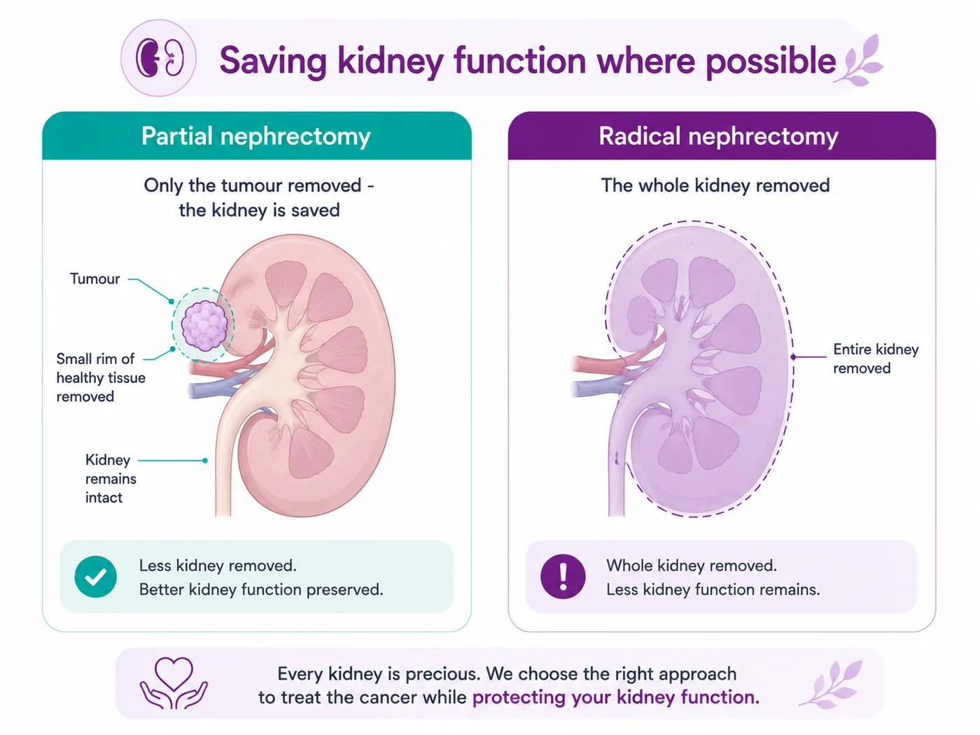 Diagram comparing partial nephrectomy (only the tumour removed, kidney saved) and radical nephrectomy (the whole kidney removed) for kidney cancer