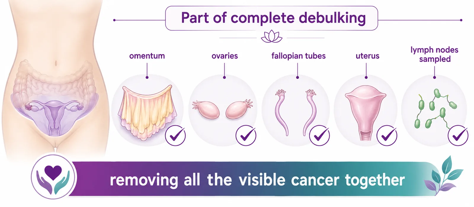 Diagram showing an omentectomy as part of complete ovarian debulking — the omentum removed together with the ovaries, fallopian tubes, uterus and sampled lymph nodes to clear all the visible cancer, CION Cancer Clinics Hyderabad