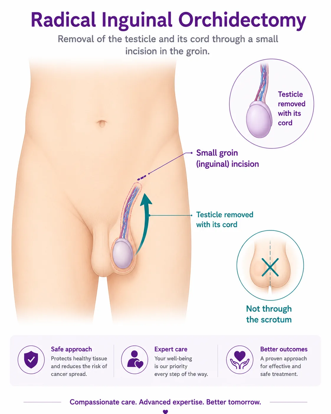 Radical inguinal orchidectomy diagram — the testicle is removed with its cord through a small groin (inguinal) incision, not through the scrotum, CION Cancer Clinics Hyderabad
