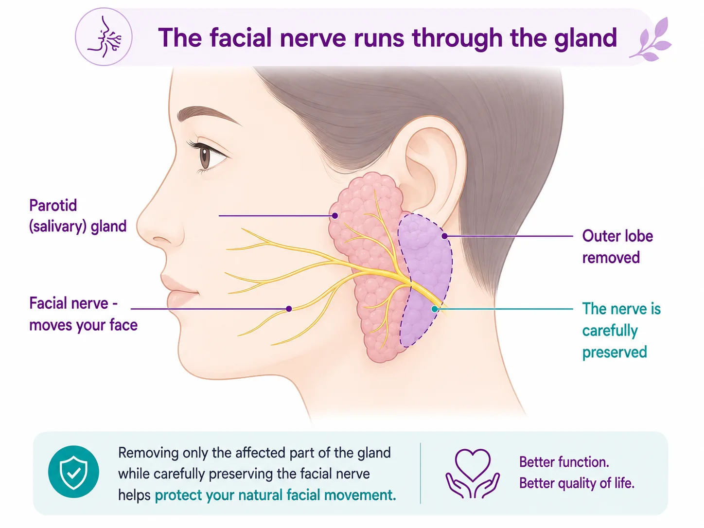 Diagram of the facial nerve running through the parotid gland in front of the ear, preserved while only the outer lobe is removed in a parotidectomy, CION Cancer Clinics Hyderabad