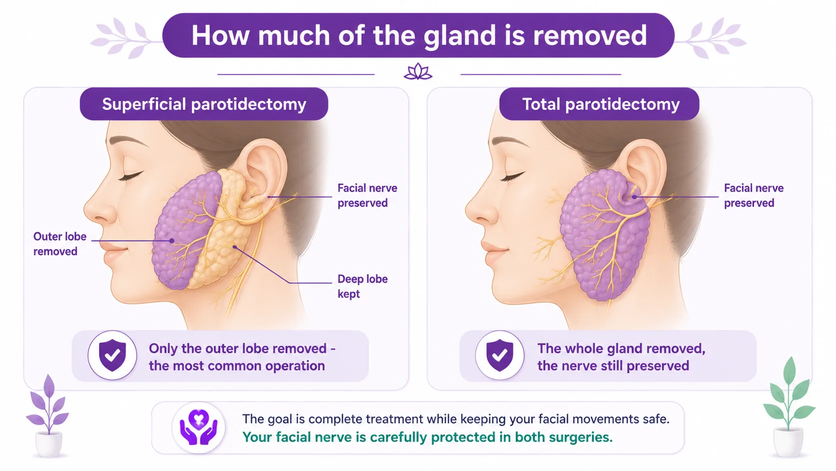 Diagram comparing superficial parotidectomy (only the outer lobe removed, deep lobe kept) and total parotidectomy (the whole gland removed), with the facial nerve preserved in both, CION Cancer Clinics Hyderabad