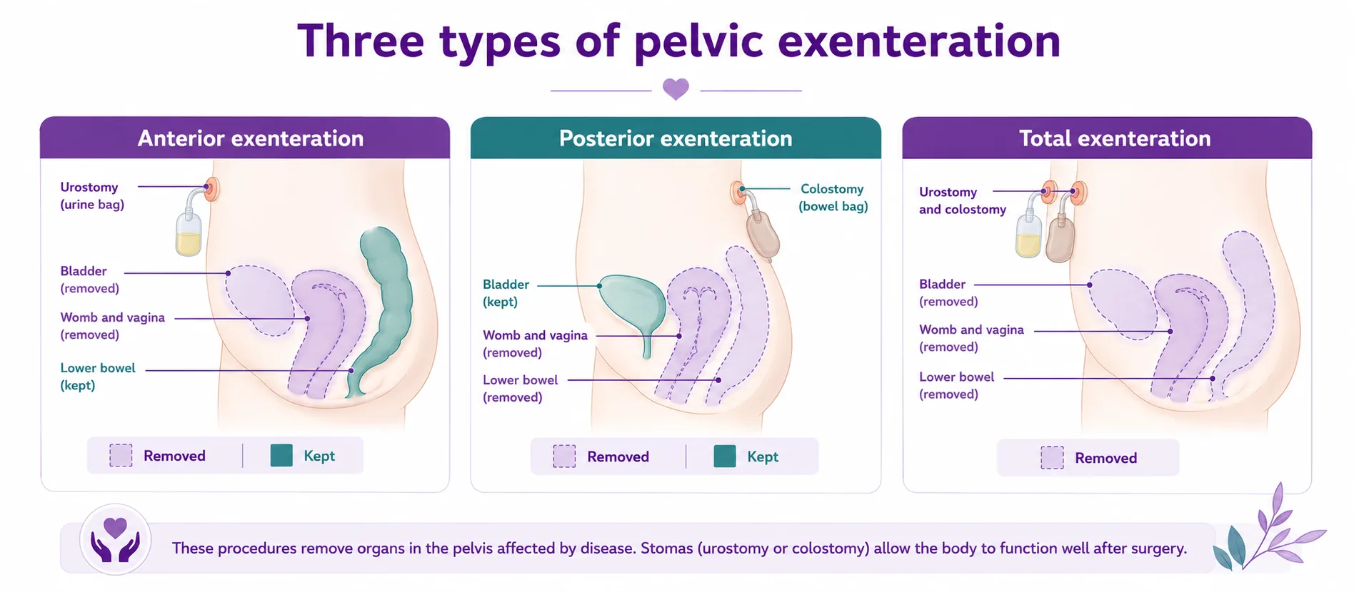 Diagram comparing anterior, posterior and total pelvic exenteration — which pelvic organs are removed and whether a urostomy, a colostomy, or both are needed, CION Cancer Clinics Hyderabad