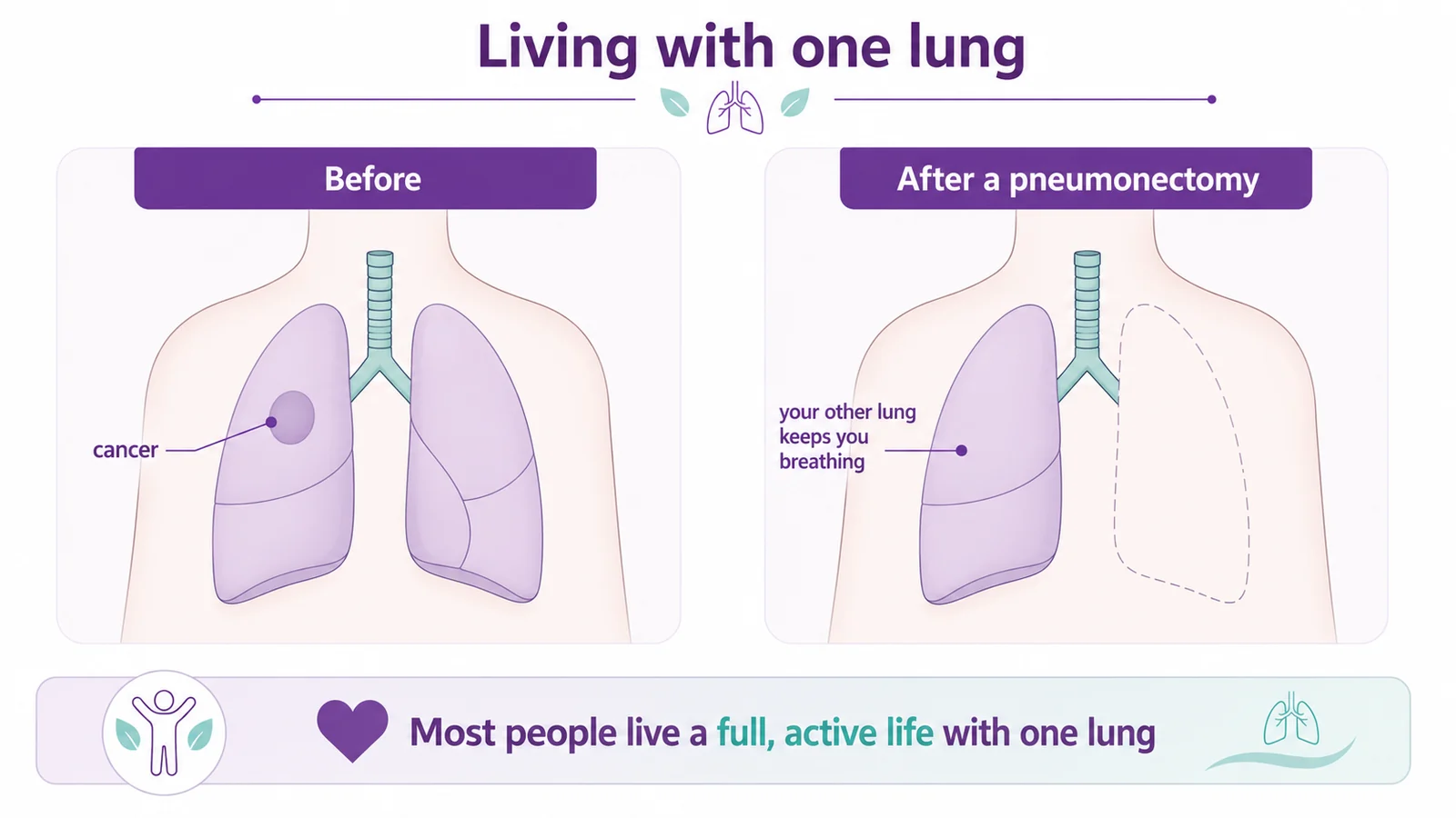 Diagram showing that after a pneumonectomy one whole lung is removed and the remaining lung keeps you breathing, so most people live a full active life with one lung, CION Cancer Clinics Hyderabad