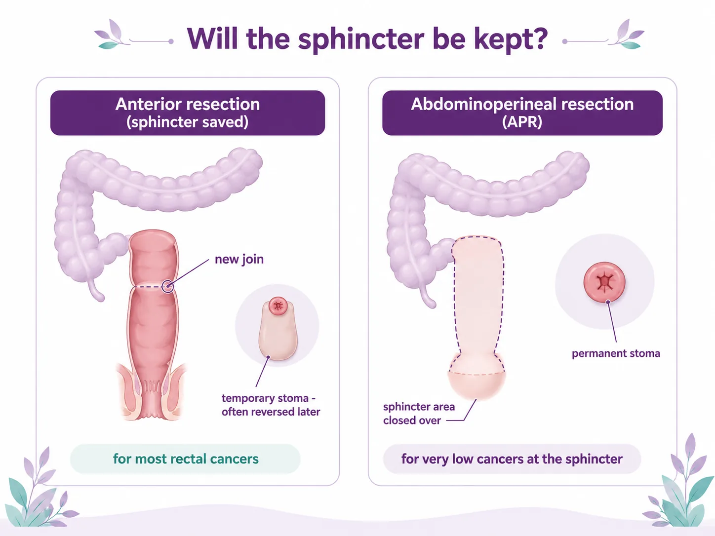Diagram comparing a sphincter-saving anterior resection with a new join and a temporary stoma that is often reversed later, against an abdominoperineal resection (APR) with the sphincter area closed over and a permanent stoma, CION Cancer Clinics Hyderabad