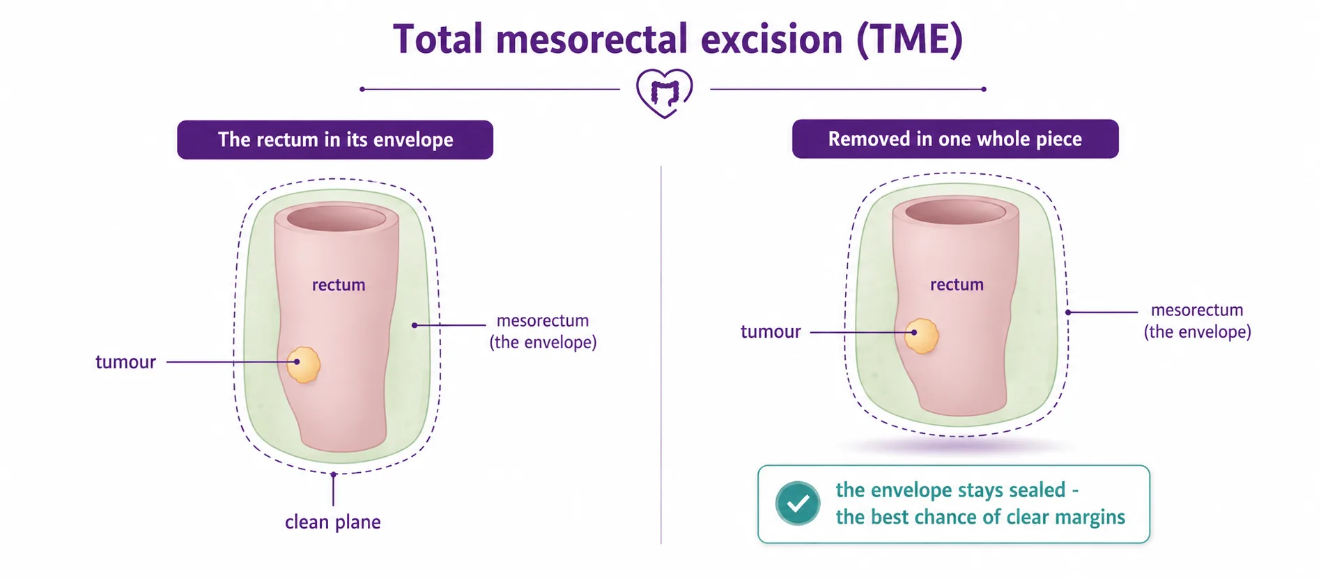 Diagram of total mesorectal excision (TME) showing the rectum and tumour inside the intact mesorectal envelope along a clean plane, then removed in one whole piece with the envelope sealed for the best chance of clear margins, CION Cancer Clinics Hyderabad